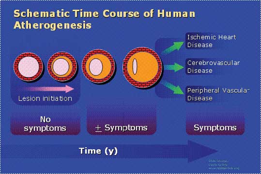 EXPRESIONES DE LA ARTERIOSCLEROSIS CON LOS AÑOS.