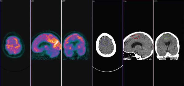 Fig . 4: Enfermedade Pic k (Demencia fr ont otemp oral ). PET-CT m uestran ormal meta bolism o mientras CT es n ormal .