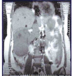 FIG. 1: MRI PARA DEFINIR TROMBOSIS VENOSA EN PACIENTE CON CÁNCER RENAL.
