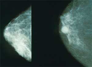 Mamografía normal (izq) y con cáncer (der)
