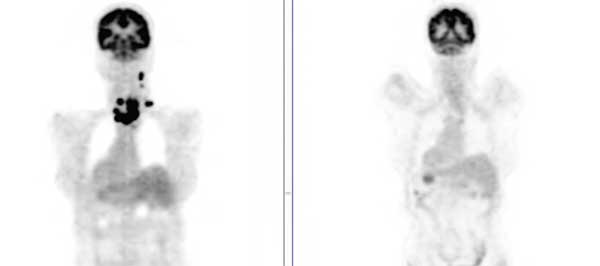 Fig 3. Mujer con diagnóstico de Linfoma no Hodgkin. Estudio PET-CT inicial y luego del primer ciclo de quimioterapia