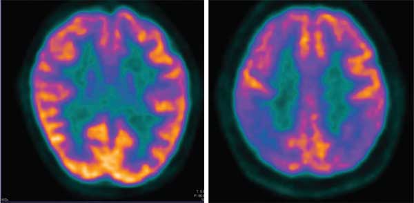 Fig. 1 y 2: PET-CT en cerebro normal y en Enfermedad de Alzheimer