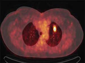 FIG. 2: PET-CT, Nódulo pulmonar superior izquierdo meta bólicamente activo.