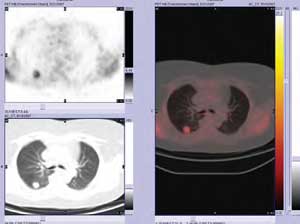 FIG. 1: Secuencia PET, CT y PET-CT: Nódulo solita rio pulmonar derecho con capta ción de FDG