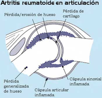 Artritis reumotoide en articulación