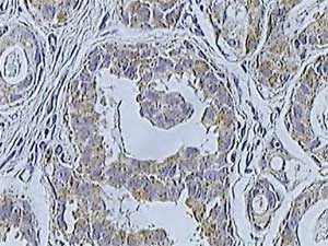 Cáncer de mama (carcinoma ductal infiltrante) estudiado con anti Her-2 anticuerpos.
