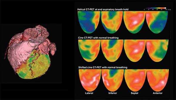 Fig. 3: Imagen digita l de PEC-CT multidetector del corazón, observán dose trayecto de coronarias.