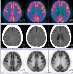 Fig. 3: PET-CT en paciente con Enfermedad de Alzheimer