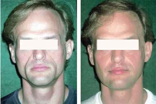 Correcciones faciales con hidroxiapatita de calcio