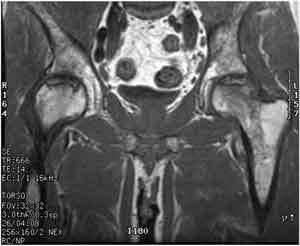 MRI de caderas (necrosis avascular)