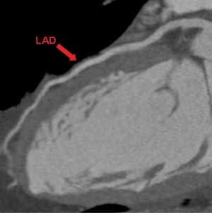 Arteria coronaria anterior descendente izquierda (LAD)