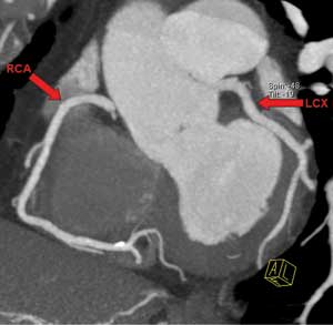 Arteria coronaria derecha (RCA), arteria coronaria circumfleja izquierda (LCX)