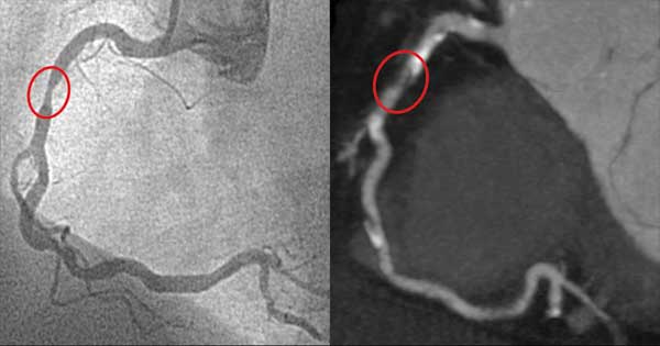 Arteria coronaria derecha por cateterismo (izquierda), por CCTA (derecha) con lesión (circulado)