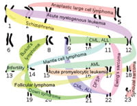 Translocaciones cromosomales (AAL: leucemia linfoblástica aguda, AML leucemia mieloide aguda, CML leucemia mieloide crónica)