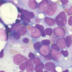 Leucemia mielógena aguda. Aspirado medular muestra leucemia mieloide aguda. (foto: Vashi Donsk, GFU Free documentation Licence 1.2)
