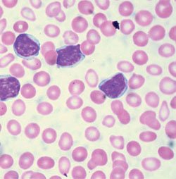Leucemia linfocítica crónica: Lámina de sangre periférica en mujer de 70 años con cuenta absoluta de 41 000 uL  linfocitos (foto Creatve Commons 2.0,Ed Uthman)