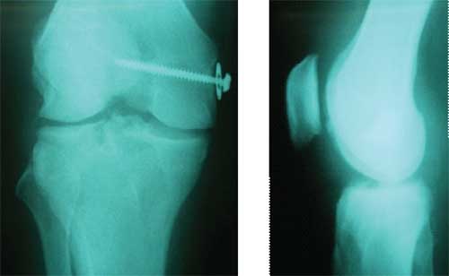 Radiografías de paciente de 38años con lesion compleja de la rodilla, a quien se le hizo reconstruccion del ligamento anterior cruzado, recosntruccion del ligamento medial colateral, microfractura del condilo medial femoral y trasplante del menisco medial.