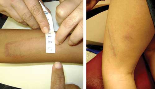 Hematomas en brazo y muslo (por correa)