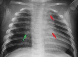 Radiografía en infante: Fracturas en costillas  (secundarias a maltrato infantil)
