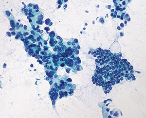 Cáncer de páncreas: Biopsia con aguja fina muestra a la izquierda tejido de adenocarcinoma y a la derecha tejido normal.