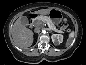 Cáncer de páncreas: Tomografía computarizada.