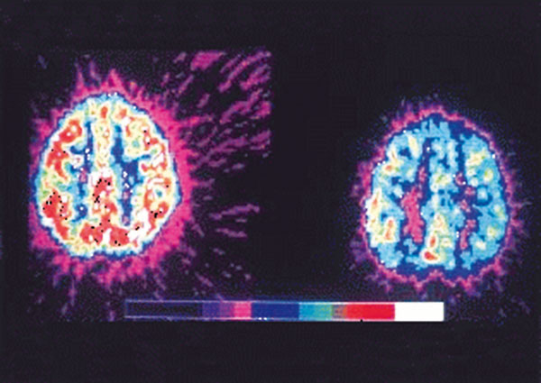 Actividad metabólica cerebral en personas sin TDAH (izquierda) y con TDAH (derecha): este síndrome conductual se asocia con patrones neurofisiológicos distintivos.