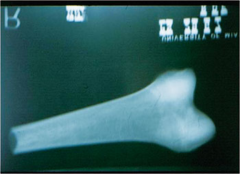 Radiografía de aloinjerto congelado para planificación quirúrgica.