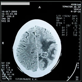Tomografía computarizada de metástasis cerebral con edema.