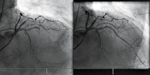 Angiografía coronaria pre y post angioplastía.