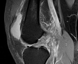 MRI de rodilla muestra lesión de ligamento anterior cruzado.