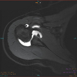 Artrografía del hombro con MRI