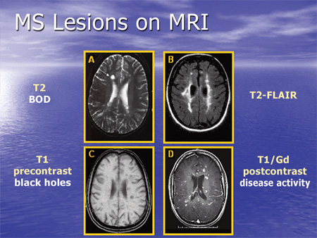 MRI: Lesiones de esclerosis múltiple (foto suministrada)