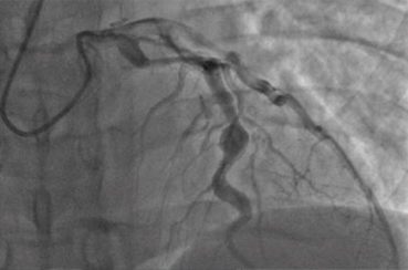 Aneurisma coronario de 6,5 mm en paciente con enfermedad de Kawasaki (Foto: mprice18,5 Dic. 2011 ccommons 3.0).