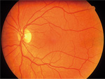 Retina Normal