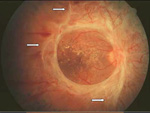 Retinopatía diabética proliferativa con desprendimiento de retina traccional.