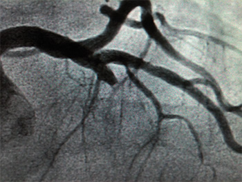 Arteria descendente anterior ocluida durante un infarto anterior agudo.