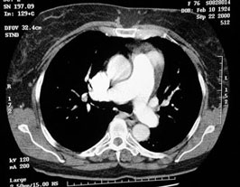 CT Scan en paciente con hipertensión pulmonar. Arterias  pulmonares prominentes sin definirse trombosis