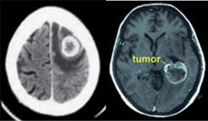 CT y MRI de masa cerebral.