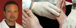 El pie doloroso  en la neuropatía  diabética