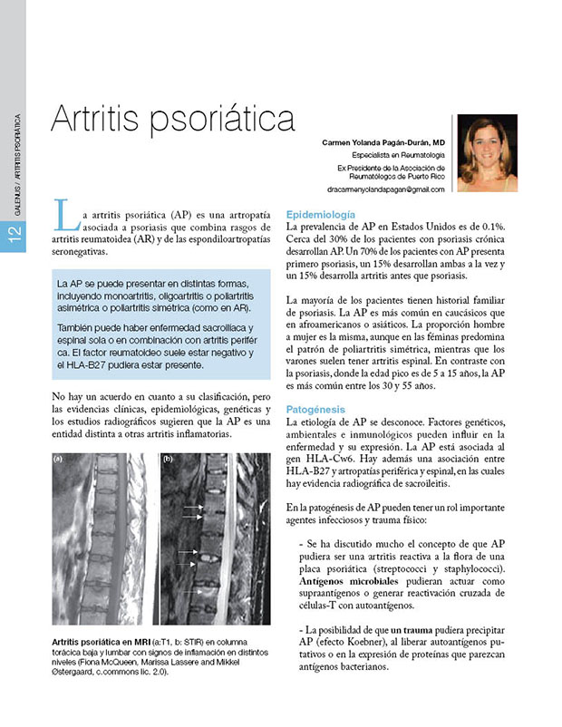 Artritis psoriática