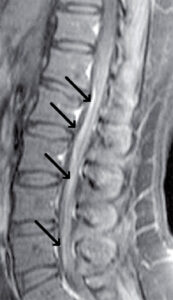 MRI, sagital T1 con contraste: Raíz raquídea de cauda equina y cono medular engrosados muestran captación de contraste.