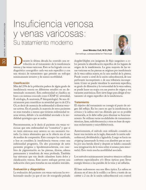 Insuficiencia venosa y venas varicosas