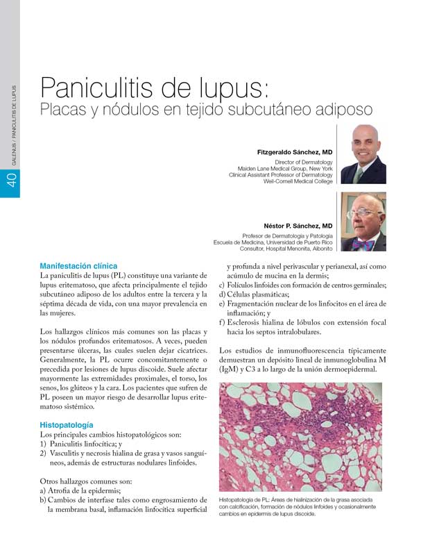 Paniculitis de lupus