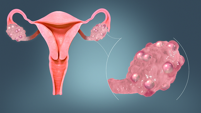 Síndrome de ovarios poliquísticos y sus efectos metabólicos